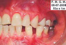 Fig. 12 – Fotografia intrabucal, lado esquerdo, 2 anos e 4 meses após o início do tratamento.