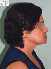 Fig. 3 – Fotografia inicial, perfil direito.