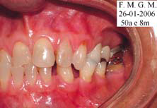 Fig. 5 – Fotografia inicial intrabucal, lado esquerdo.